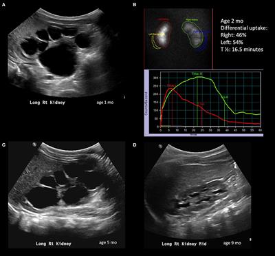 Managing Ureteropelvic Junction Obstruction in the Young Infant
